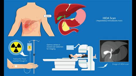 hida scan market|Hepatobiliary Iminodiacetic Acid Scan .